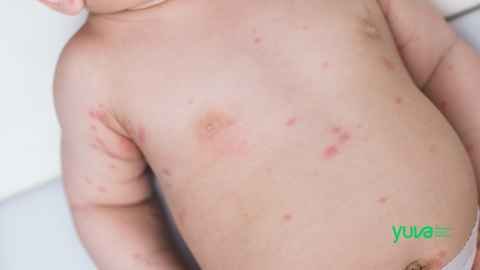 Bebeklerde İsilik Neden Olur, Nasıl Geçer? | Etkili ve Güvenli Çözümler Bebeklerde İsilik Neden Olur, Nasıl Geçer? | Etkili ve Güvenli Çözümler